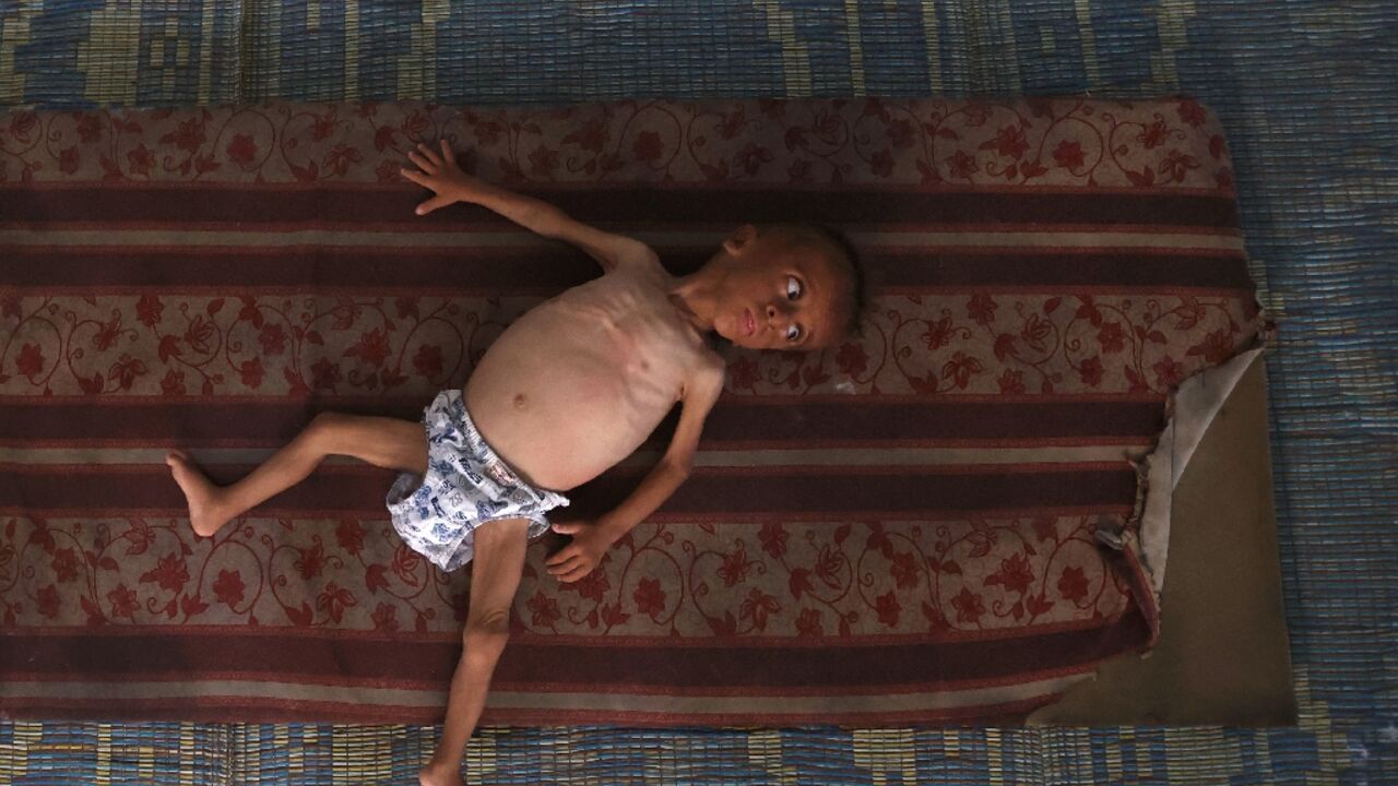 Mohammed al-Mutawaq, an 18-month-old Palestinian boy, inside a tent in the Al-Shati refugee camp west of Gaza City, on July 24, 2025 
