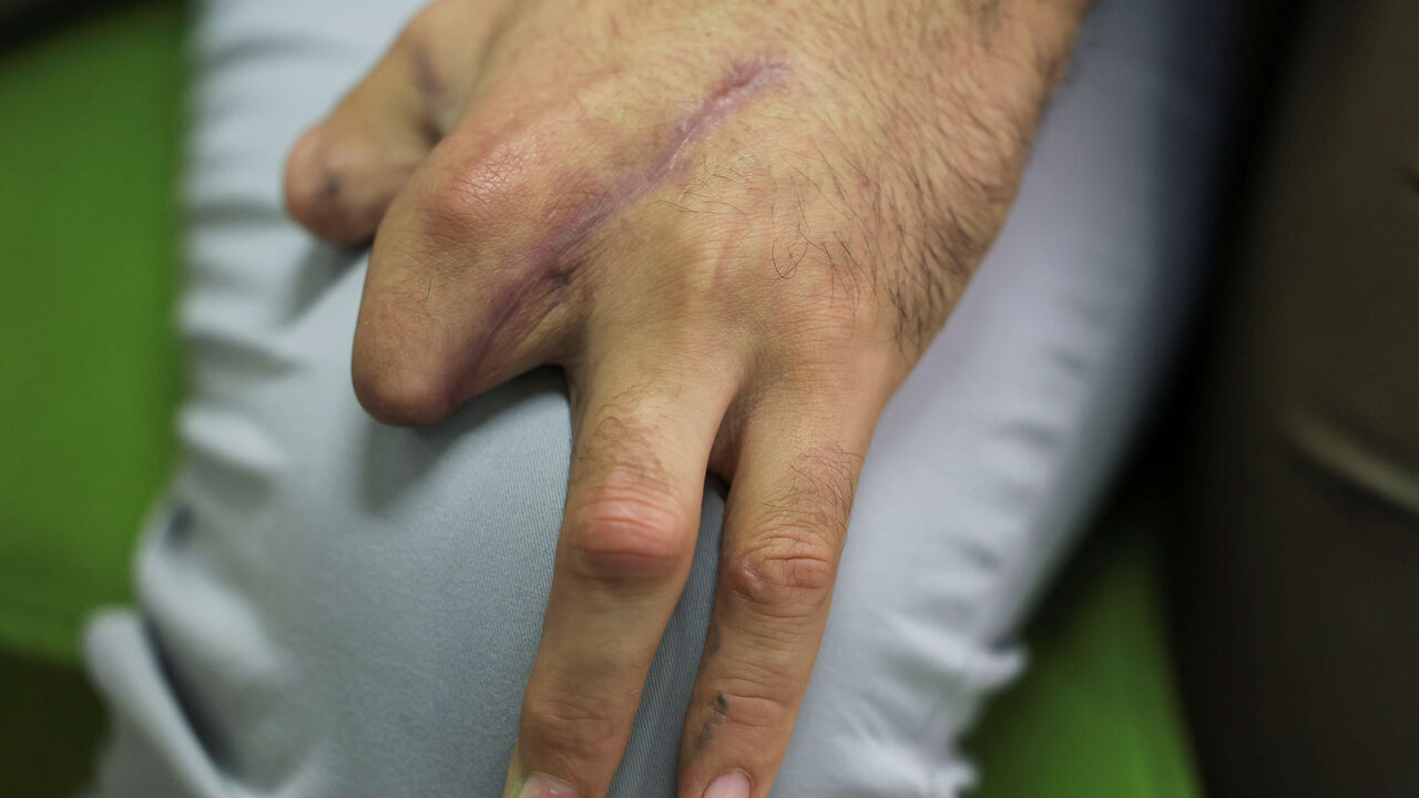 Mohammed Nasser al-Din, 34, director of the Engineering and Medical Equipment Department at Al-Rasoul Al-Aazam Hospital, a Hezbollah-affiliated facility, and was wounded when pagers detonated across Lebanon on September 17, 2024, sits in a room with some fingers missing, in Beirut, Lebanon September 15, 2025. REUTERS/Mohamed Azakir