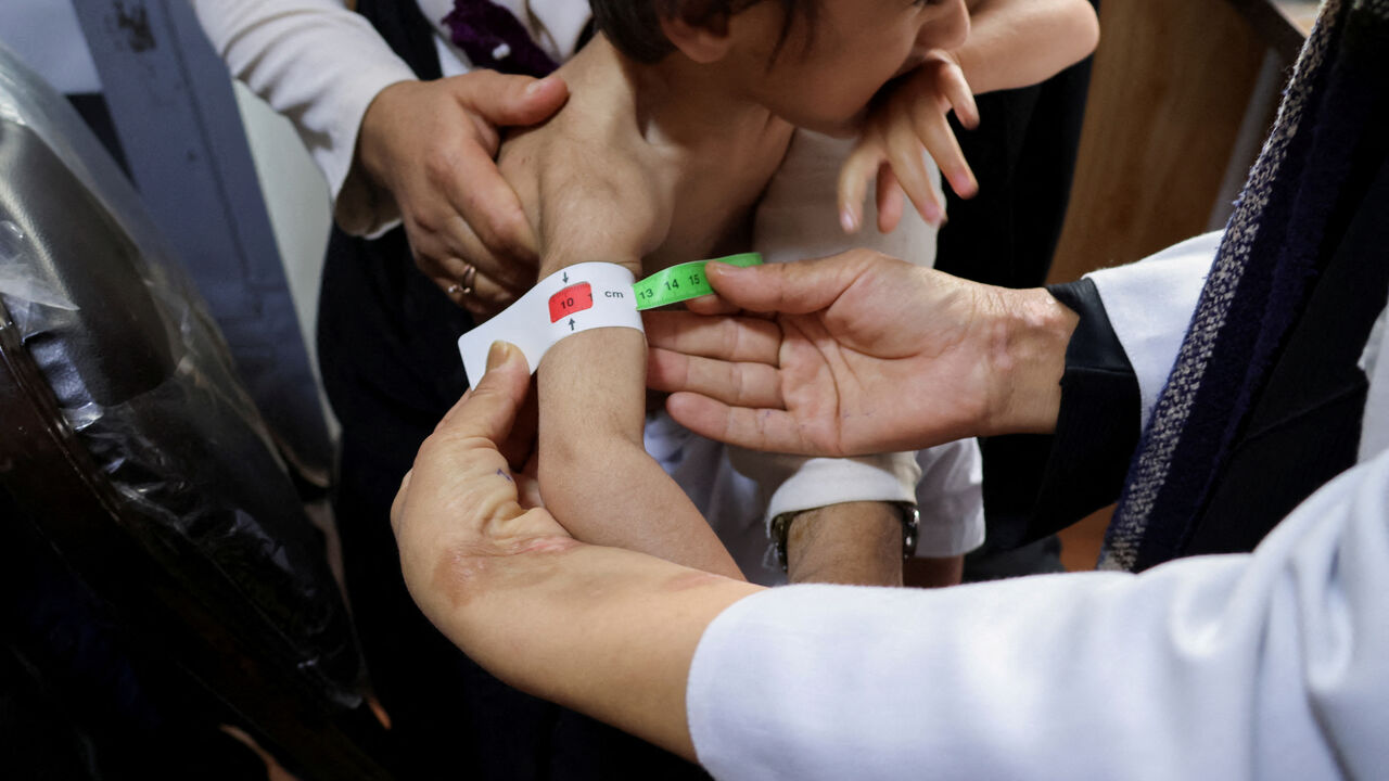 FILE PHOTO: A doctor measures the upper arm of a three-year-old boy suffering from severe acute malnutrition, at Yaka Dokan health clinic, Herat, Afghanistan, October 23, 2024. REUTERS/Charlotte Greenfield/File Photo