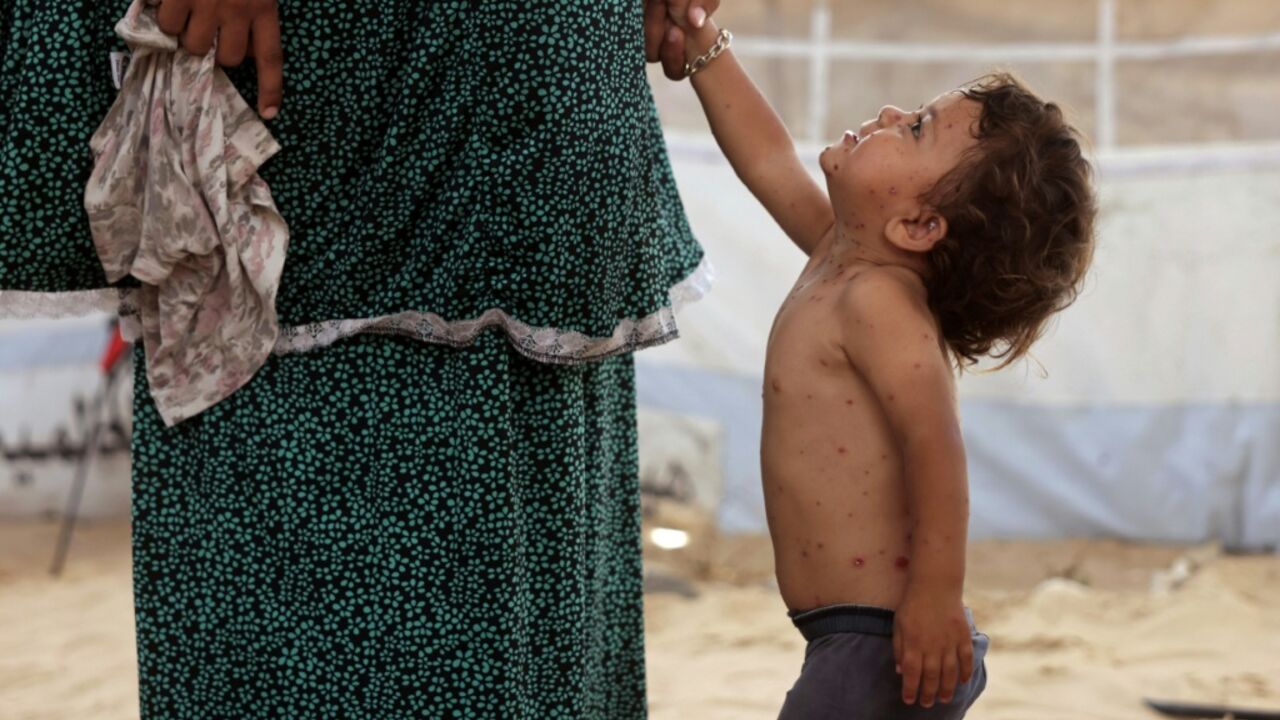 UNICEF said health officials had already recorded more than 9,300 suspected cases of chickenpox across Gaza in early July