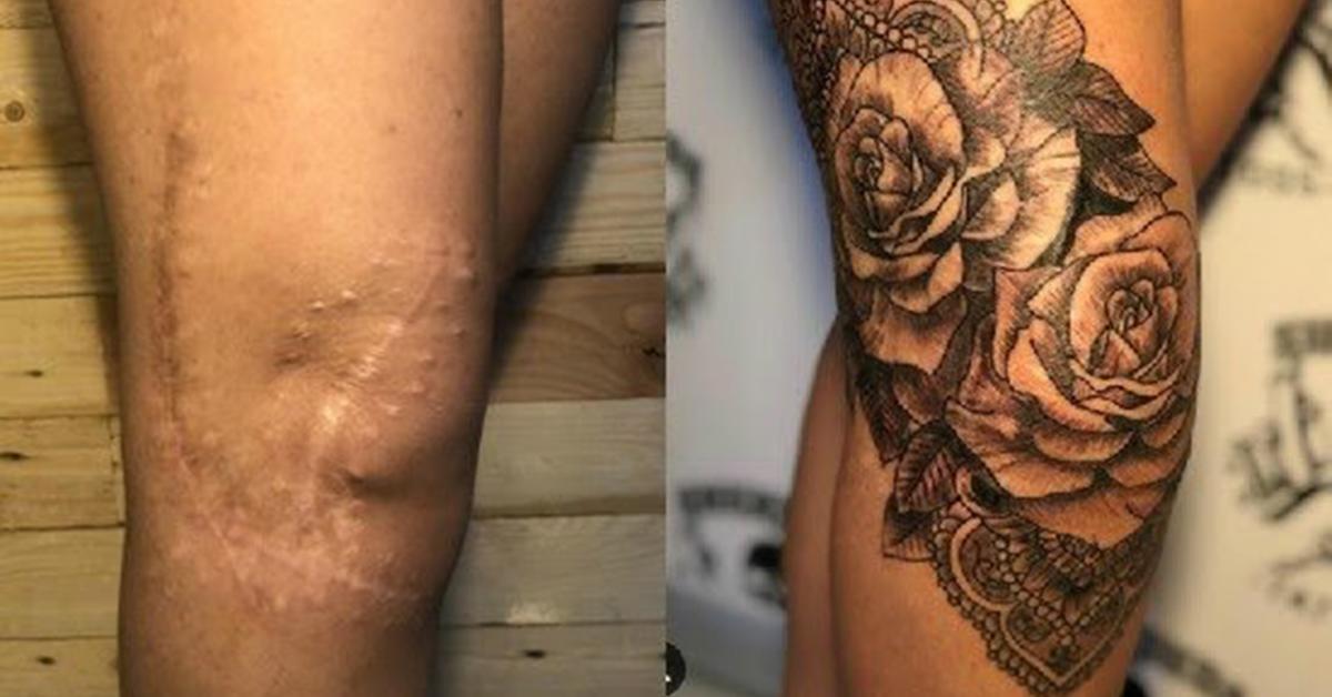 Tattooing Over Scars  NAOHOA